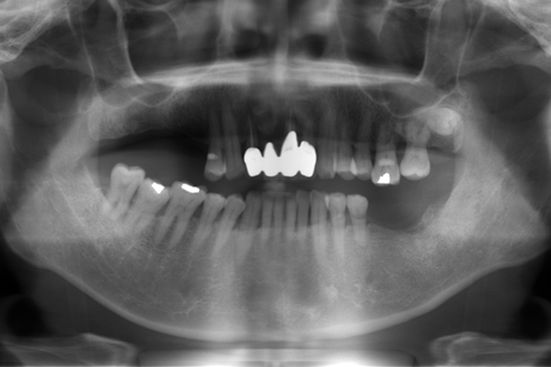 水雷射植牙重建