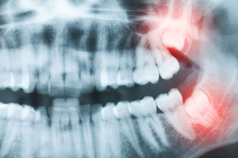 口衛教室|缺牙怎麼辦