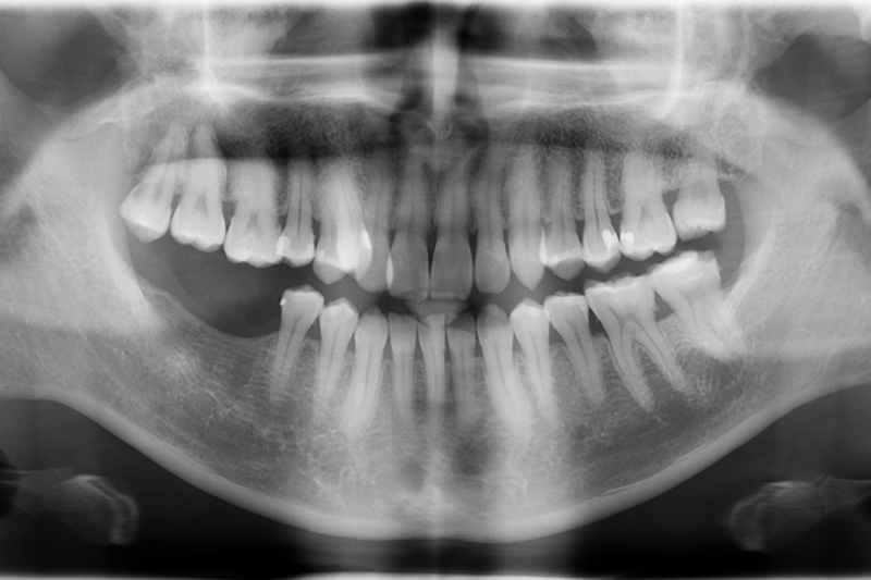 3D水雷射微創植牙
