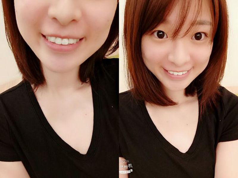 林口牙醫推薦/林口牙齒美白 萊德美學牙醫診所 洗牙及牙齒美白評估紀錄（林口A9捷運站步行約15分鐘/三井OUTLET東口旁）