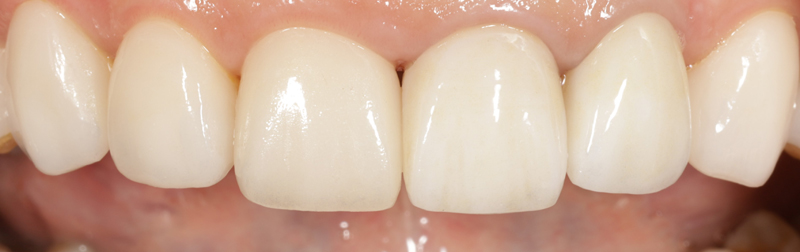 水雷射牙齦美容+陶瓷貼片