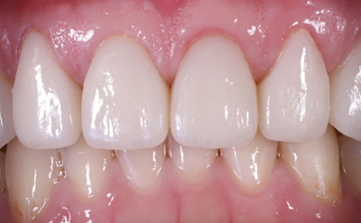 一日美齒+雷射美白