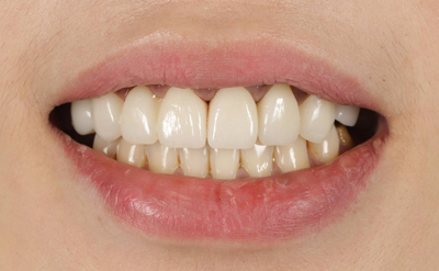 他家診所舊假牙更換