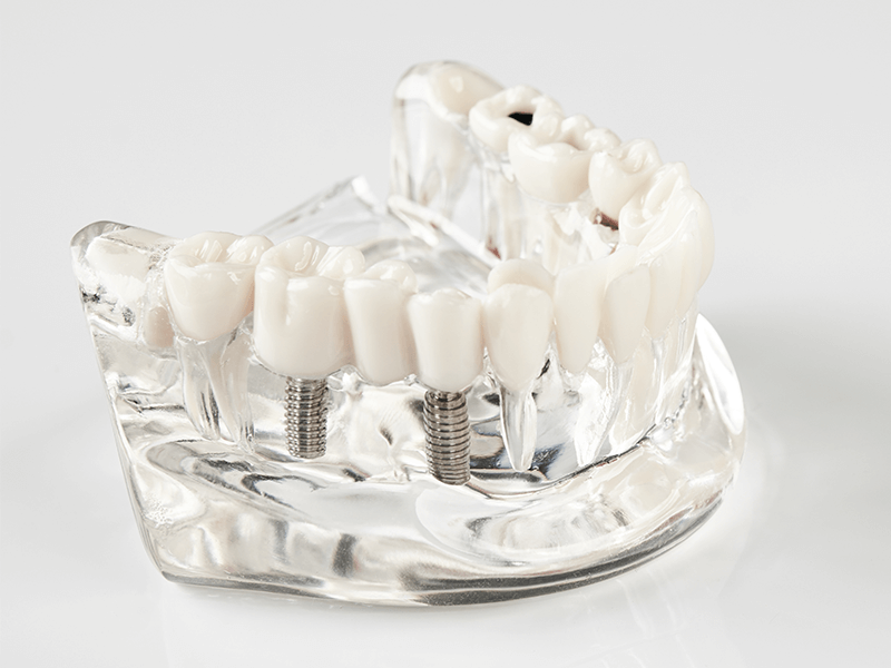 植牙術後雷射修復